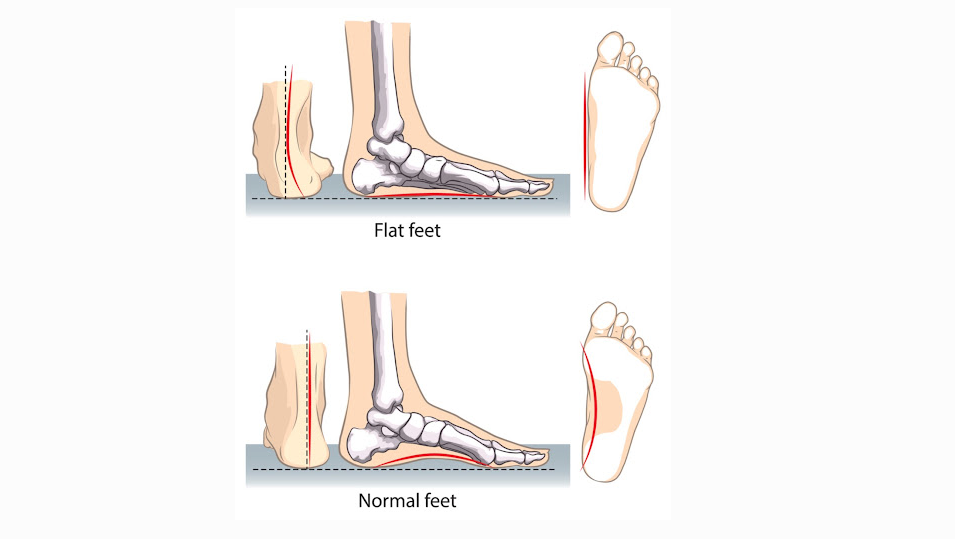8 Reasons You Need Flat Foot Surgery in Singapore