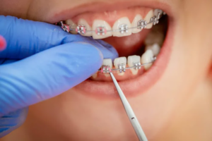 Life-Changing Benefits of Orthodontic Treatment You Never Knew Existed